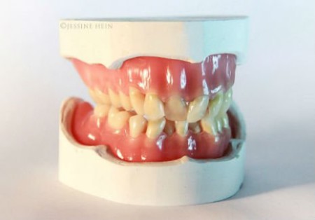 david-bowie-dentures-1