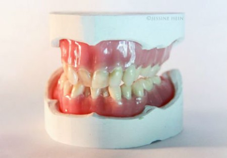 david-bowie-dentures-2
