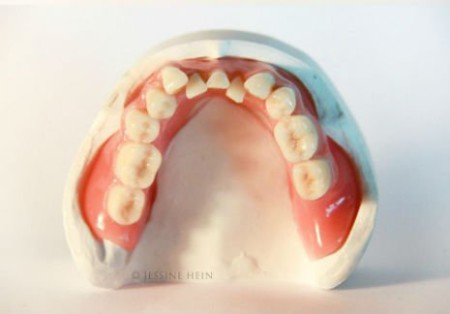 david-bowie-dentures-3