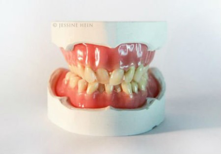 david-bowie-dentures-4